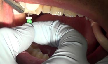 مراقبت‌های بعد از عصب کشی دندان